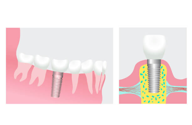 dental-implant-illustration img