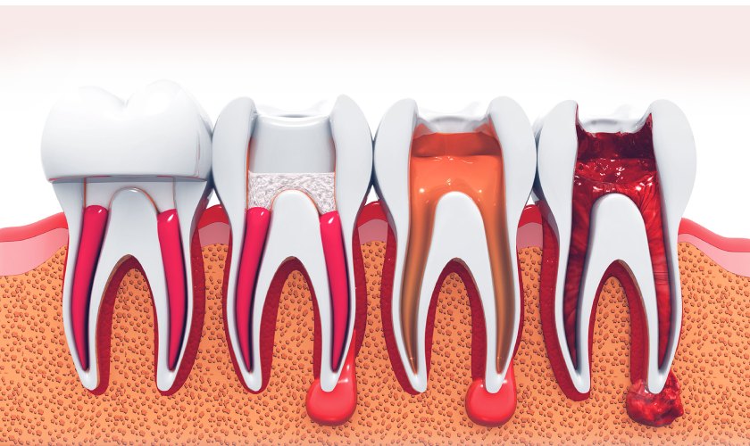 tooth that needs root canal