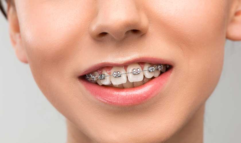 4 Benefits of Choosing Six Month Smiles for Straighter Teeth