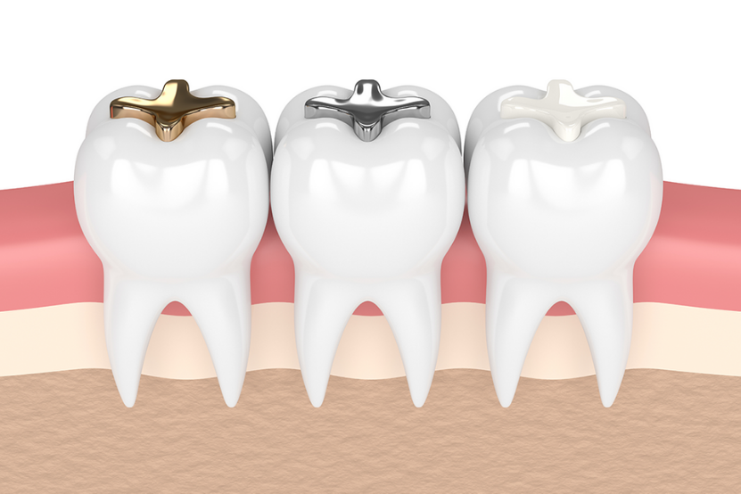 dental sealants
