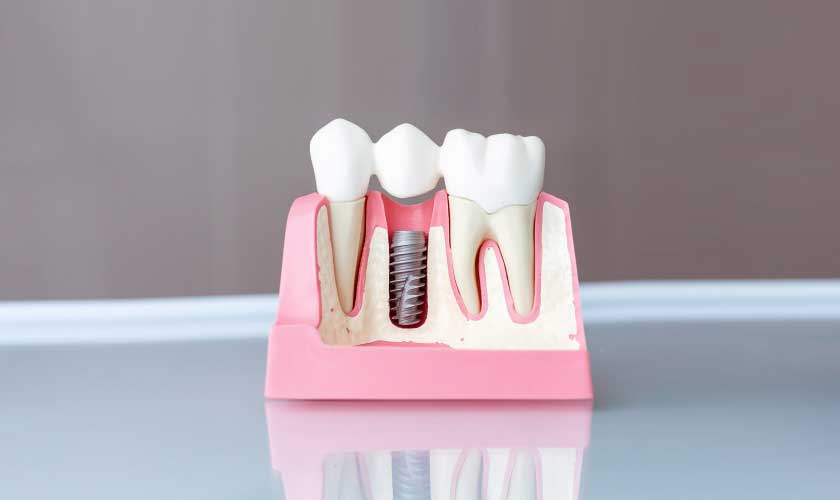 Cost of Dental Implants