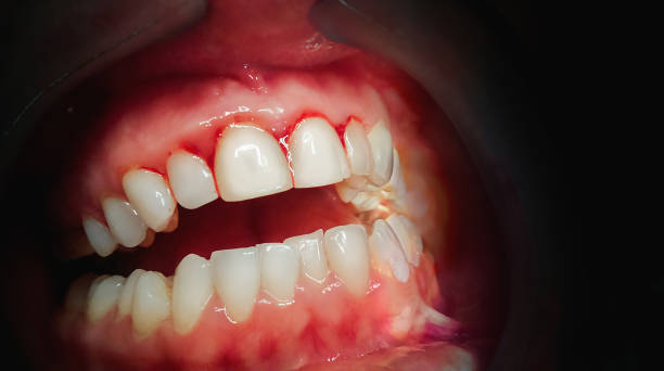 Gingivitis – Factors and Symptoms