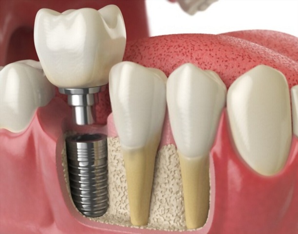 Dental Implants