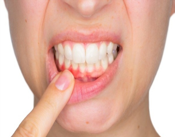 How to prevent gum disease?