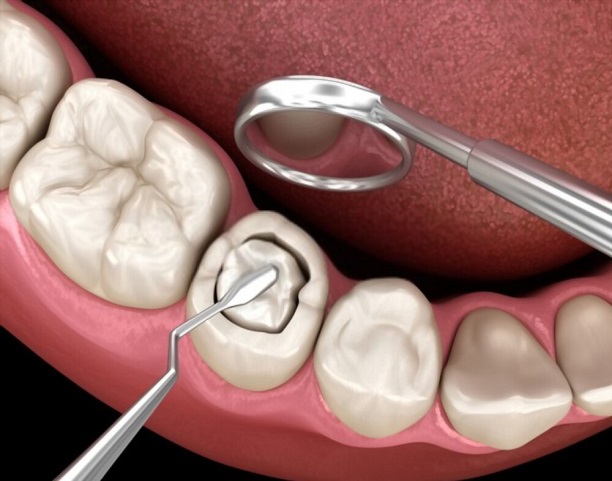 Everything You Need To Know About Composite Fillings