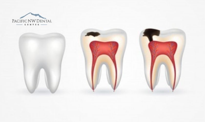 Five Common Signs Of Root Canal Infection