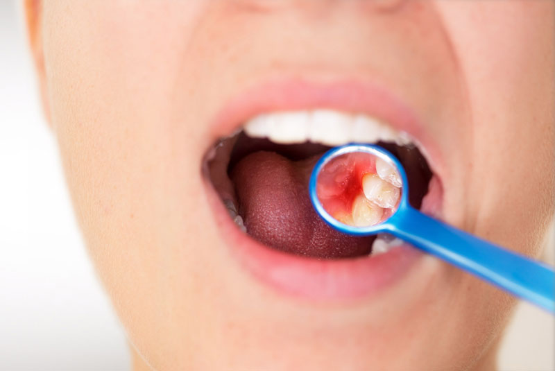 a close up picture of a patients open mouth being examined by a doctor because she has gum disease.