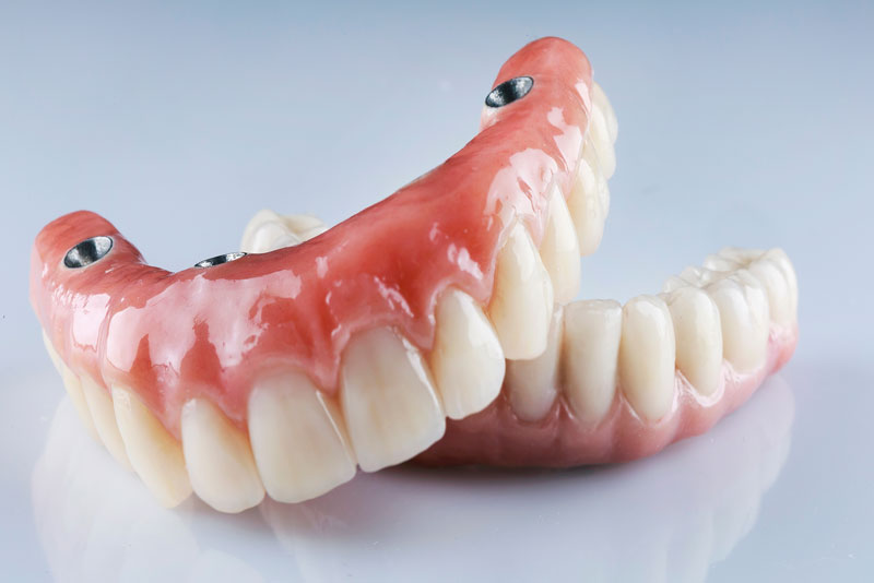 an image of two full arch dental implant models that can be shown to patients before they have their guided dental implant surgery for full mouth dental implants.