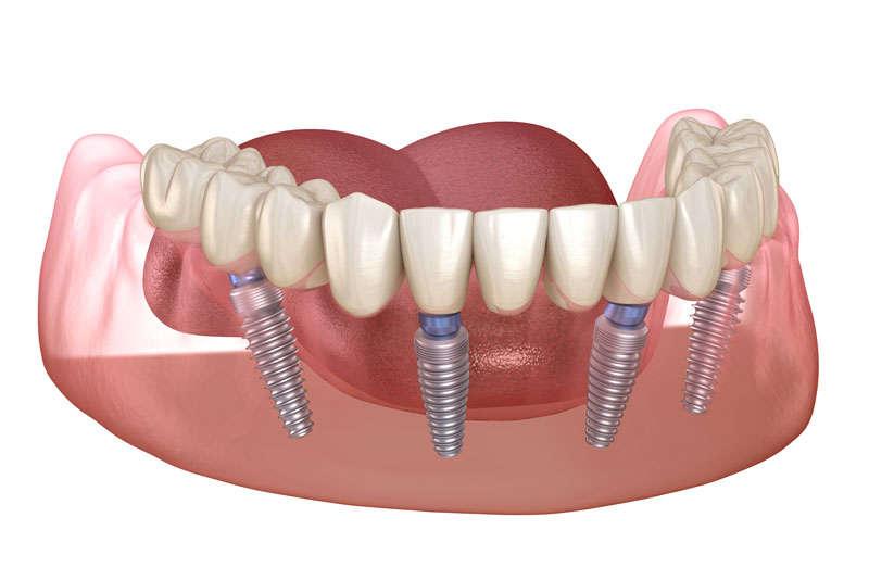 this image of an all-on-4 dental implant model shows that for people with jawbone loss, four dental implant posts can stimulate the jawbone back to health.