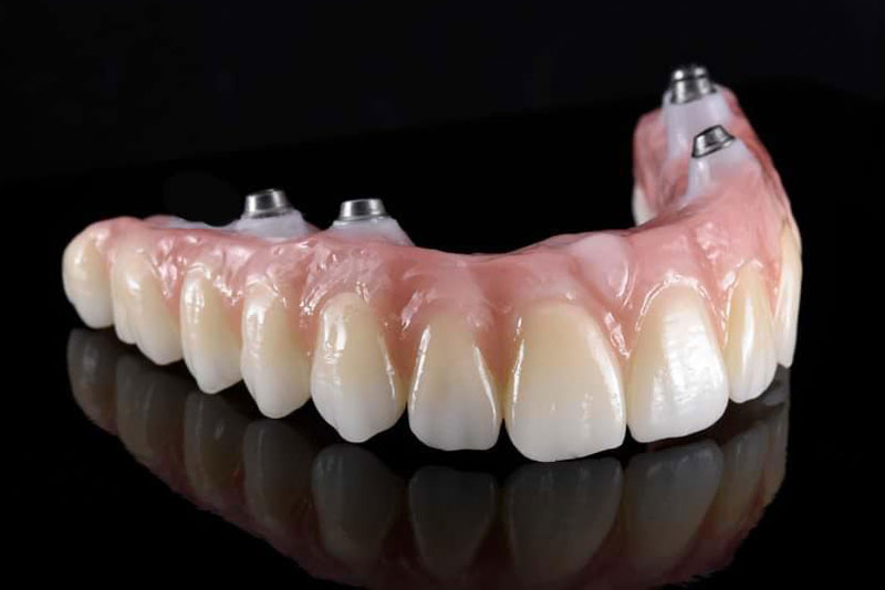 a zirconia bridge with dental implants in it that can be used in a beneficiary zirconia fixed bridge procedure.