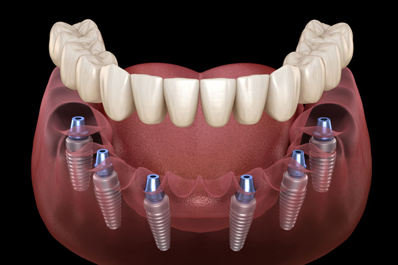 a full mouth dental implant model showing how the six dental implants are going to secure the zirconia fixed bridge in place.