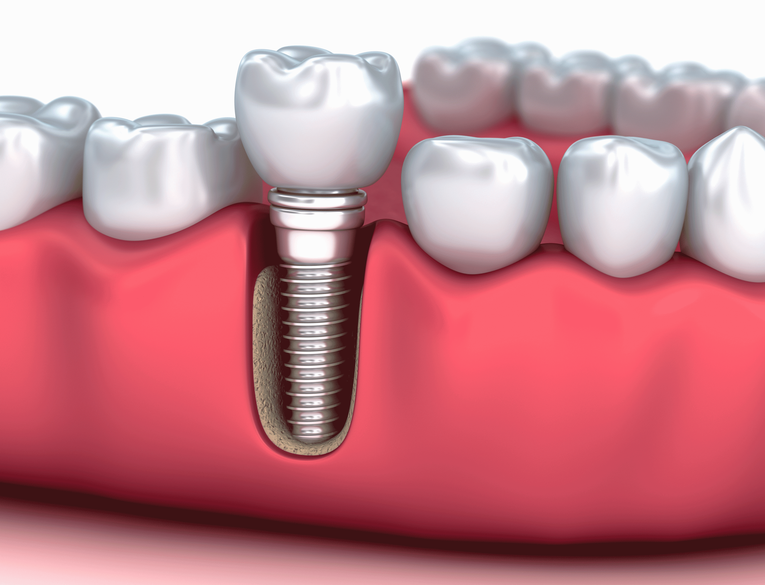 Should I Get Treated With Dental Implants After Tooth Extractions?