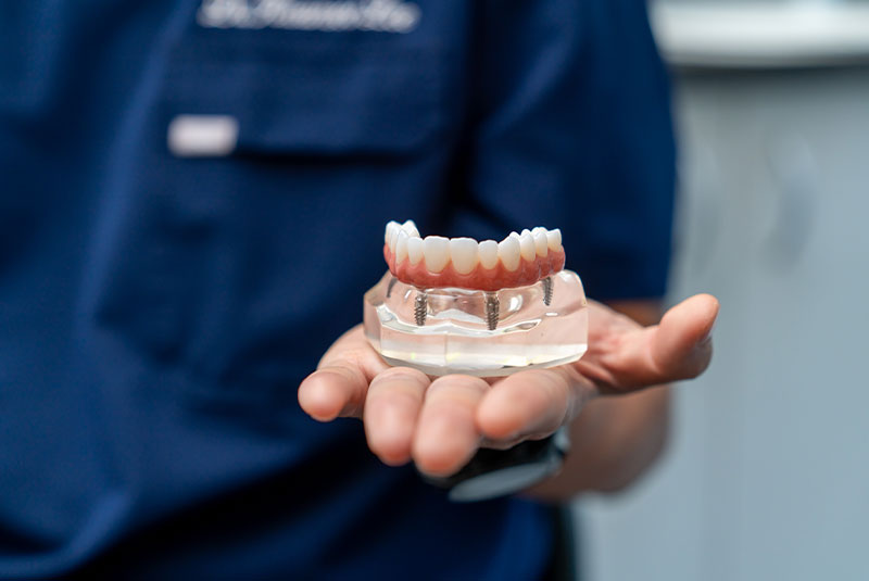 model of dental implants